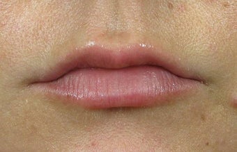 Lip Augmentation with Lip Implants before 1239496