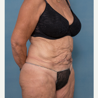 55-64 year old woman treated with Abdominoplasty and Ventral Hernia Repair before 3532569