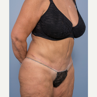 55-64 year old woman treated with Abdominoplasty and Ventral Hernia Repair after 3532569
