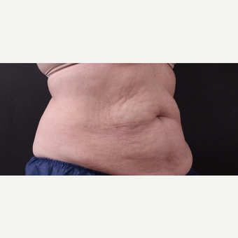 62 year old woman treated with CoolSculpting before 3221080