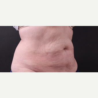 62 year old woman treated with CoolSculpting after 3221080