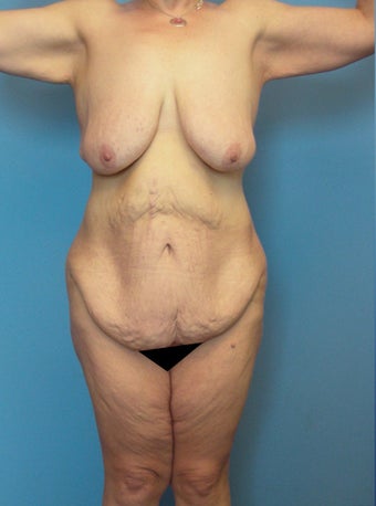 Body Lift before 216788