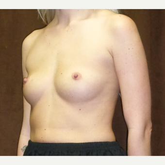 25-34 year old woman treated with Breast Implants before 2724197