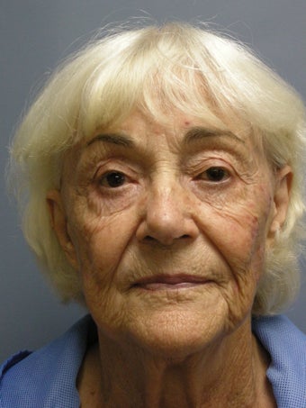 LiteLift™ and Blue Peel® on 79-year-old Woman before 1149632
