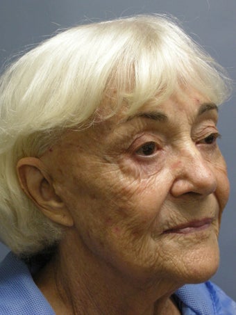 LiteLift™ and Blue Peel® on 79-year-old Woman 1149632