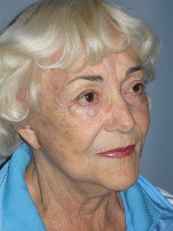 LiteLift™ and Blue Peel® on 79-year-old Woman 1149632