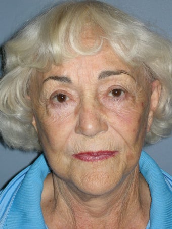 LiteLift™ and Blue Peel® on 79-year-old Woman after 1149632