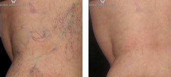 Spider Veins after 1 Sclerotherapy session before 1508162