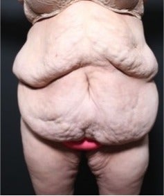 25-34 year old woman treated with Panniculectomy before 1957275