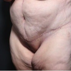 25-34 year old woman treated with Panniculectomy 1957275