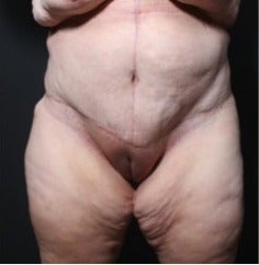 25-34 year old woman treated with Panniculectomy after 1957275