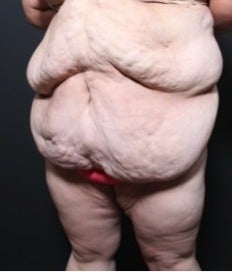 25-34 year old woman treated with Panniculectomy 1957275