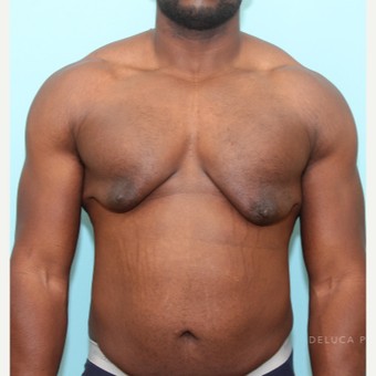 Skin Excision and Nipple Grafting For Severe Gynecomastia before 3446807