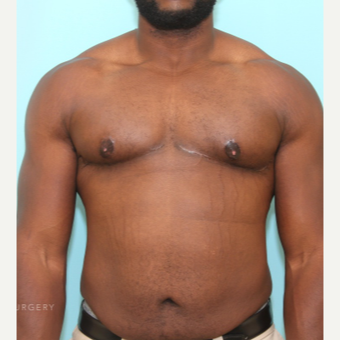Skin Excision and Nipple Grafting For Severe Gynecomastia after 3446807