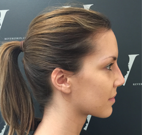Instant visible results with the non surgical nose job after 3358416