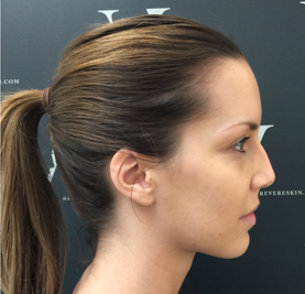 Instant visible results with the non surgical nose job before 3358416