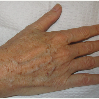 55-64 year old woman treated with IPL before 3091049