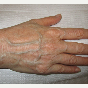 55-64 year old woman treated with IPL after 3091049