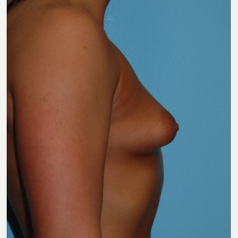 20 year old woman treated with 325 cc MPP implants filled to 350 cc, A to full C cup before 3776049