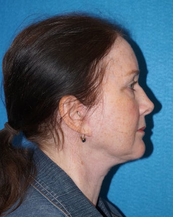56 year old woman treated with Facelift 2493183
