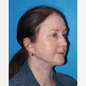 56 year old woman treated with Facelift after 2493183