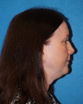 56 year old woman treated with Facelift 2493183
