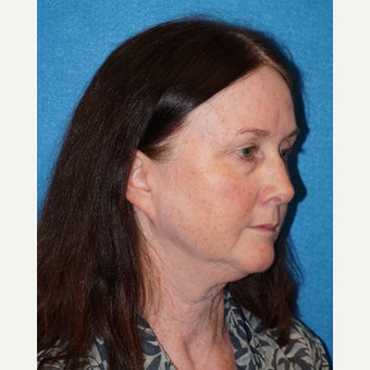 56 year old woman treated with Facelift before 2493183