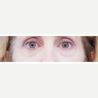 45-54 year old woman treated with Eye Bags Treatment before 3698487