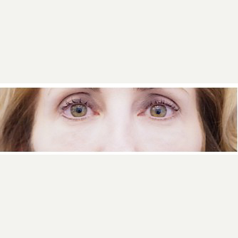 45-54 year old woman treated with Eye Bags Treatment after 3698487