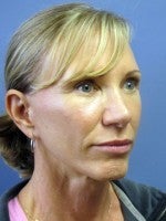 55-64 year old woman treated with Neck Lift before 3103899