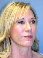 55-64 year old woman treated with Neck Lift after 3103899