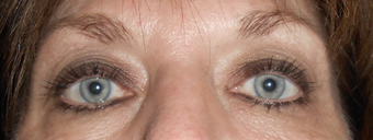 Botox and Exilis around the eys after 1242371