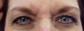 Botox and Exilis around the eys before 1242371