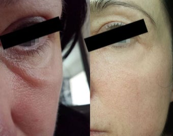 35-44 year old woman treated with Laser Treatment before 2308256