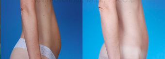 Mini Tummy Tuck with Diastasis Repair after 945614