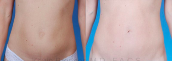 Mini Tummy Tuck with Diastasis Repair before 945614
