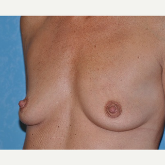 45-54 year old woman treated with Breast Augmentation before 3732868