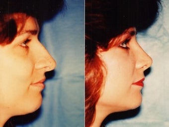 36yo Dr Mark Prysi performed rhinoplasty before 1245710