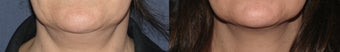 Ulthera Neck | Before and After before 1033995