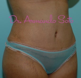 Abdominoplasty (Tummy Tuck) after 207532