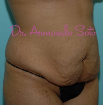 Abdominoplasty (Tummy Tuck) before 207532