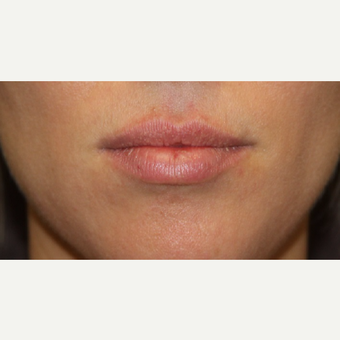 25-34 year old woman treated with Juvederm before 3147430