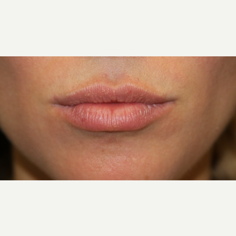 25-34 year old woman treated with Juvederm after 3147430