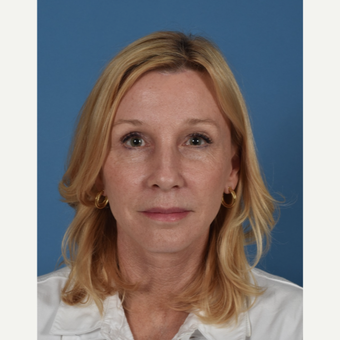 55-64 year old woman treated with Facelift after 3437560