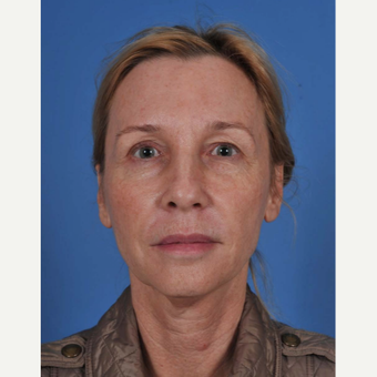 55-64 year old woman treated with Facelift before 3437560
