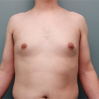 Male Breast Reduction Performed Using Liposuction before 3467007