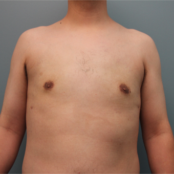 Male Breast Reduction Performed Using Liposuction after 3467007