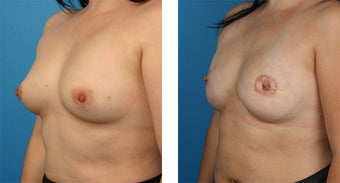 28 Year Old Woman, Cassileth One-Stage Breast Reconstruction 1039922