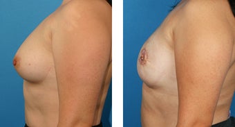 28 Year Old Woman, Cassileth One-Stage Breast Reconstruction after 1039922