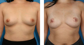 28 Year Old Woman, Cassileth One-Stage Breast Reconstruction before 1039922